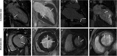 Alteration of cardiac structure and function and its prognostic value in patients with Takayasu arteritis: a cardiac magnetic resonance study